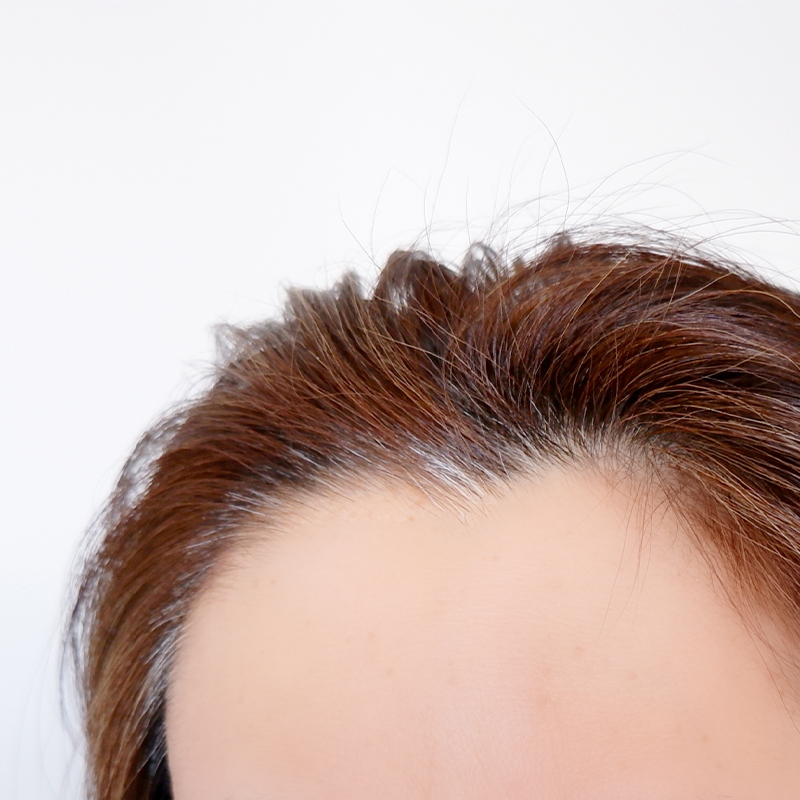 ヘアーフィラー（毛髪再生治療）の効果イメージ画像